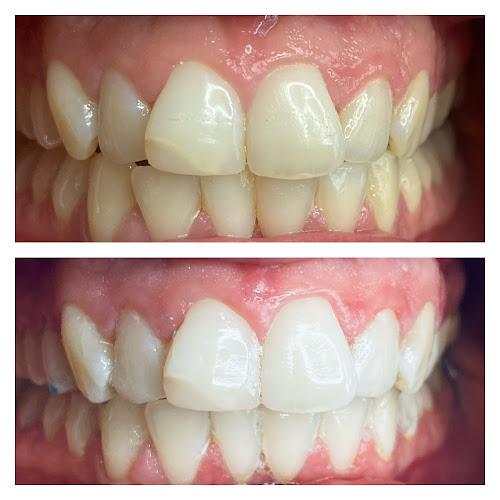 Teeth whitening and Aesthetics