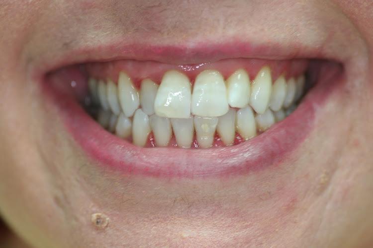 Teeth Whitening London