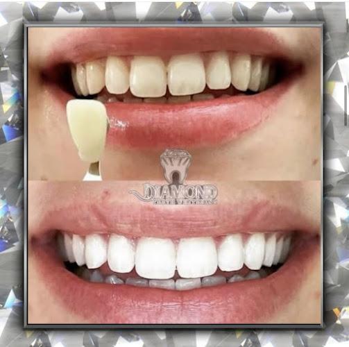 Naturawhite Laser Teeth Whitening Birmingham