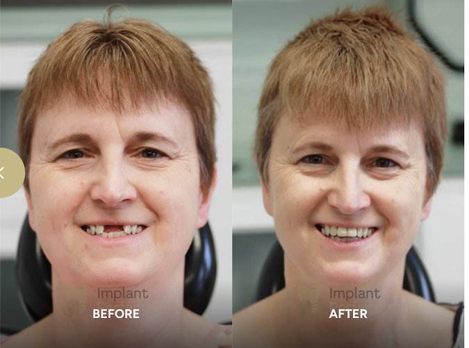 Implant Perfection - Dental Implants Derby