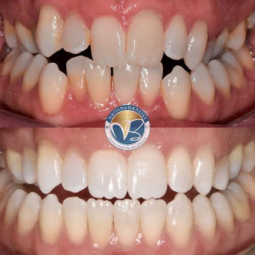 Smile Bristol - Invisalign and ClearCorrect Aligner Orthodontics in Bradley Stoke