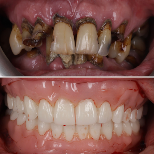 Digital dentures Glasgow, scan and fit